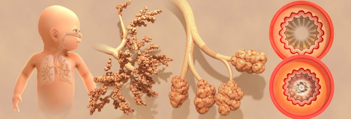 pls-bronchiolite